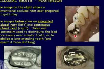 Lecture: Classification and components of removable partial dentures