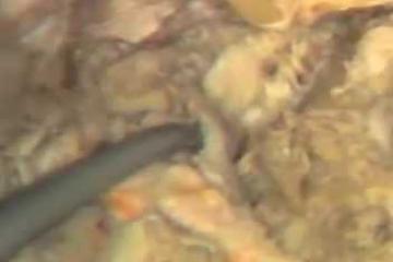 Lecture: TMJ, Pterygoid Muscles, Maxillary Vessels