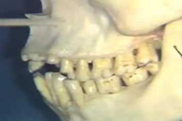 Lecture: Nerve Supply to Teeth; Maxillary Sinus