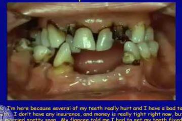 Lecture: Two-implant supported overdenture treatment