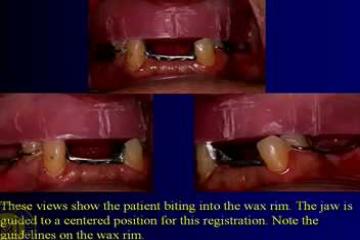 Lecture: Implant-supported dentures