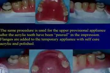 Lecture: Rotational path partial dentures