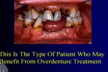 Lecture: Partial denture attachments