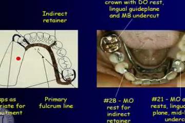 Lecture: Removable partial dentures: design considerations