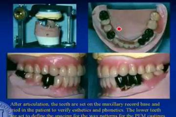 Lecture: Tooth supported overdentures