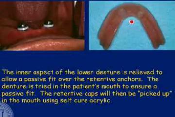 Lecture: Immediate Insertion Removable Appliances